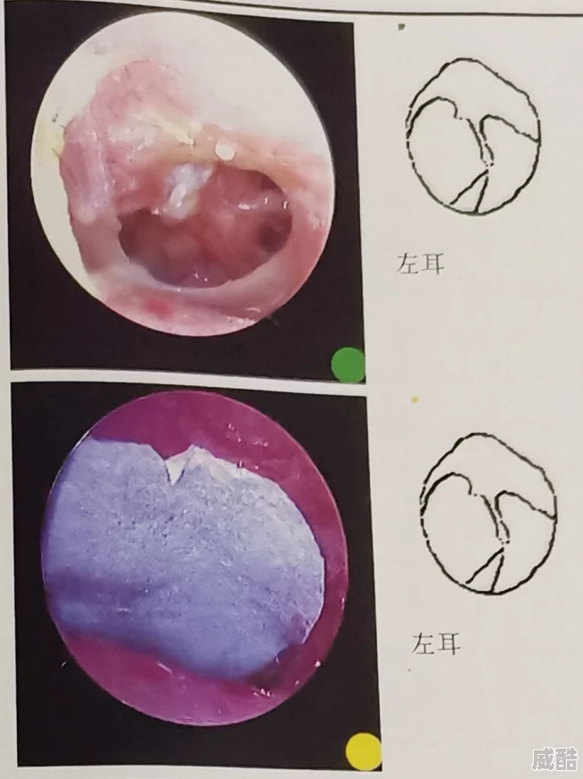 拨萝卜又痛又听患者称医院操作不当导致鼓膜穿孔卫生部门已介入调查