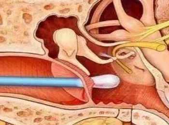 拨萝卜又痛又听患者称医院操作不当导致鼓膜穿孔卫生部门已介入调查